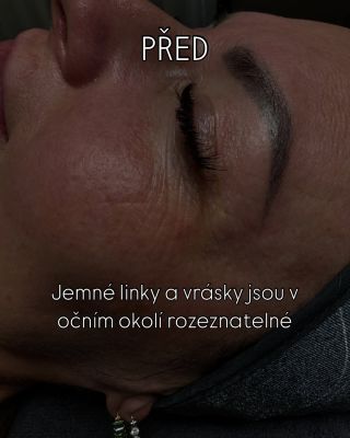 Procedura ProFirm je založena na hydrataci, vyživení vitamíny a řešení vrásek. Tohle je výsledek po jednom sezení 💁🏼‍♀️💅💃